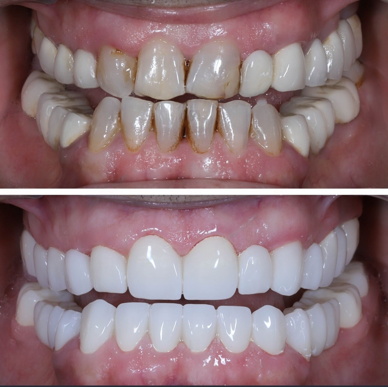 before and after composite veneer03